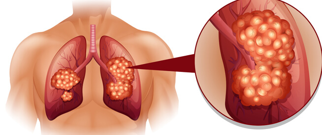 سرطان الرئة تعرف على أبرز المعلومات