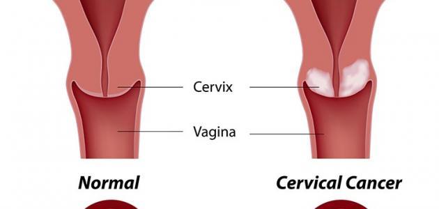 سرطان الرحم للبنات