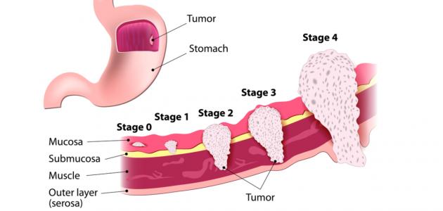 سرطان المعدة وأعراضه