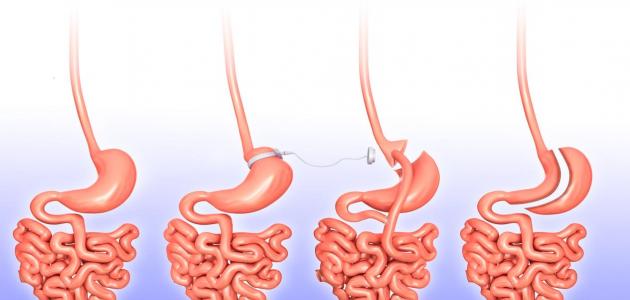 سلبيات عملية تحويل مسار المعدة