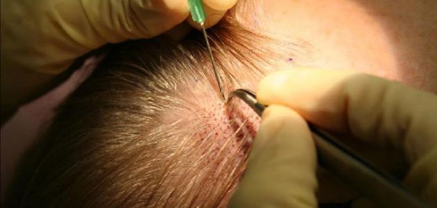 طريقة زراعة الشعر