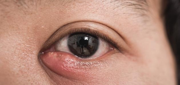طريقة علاج دمل العين
