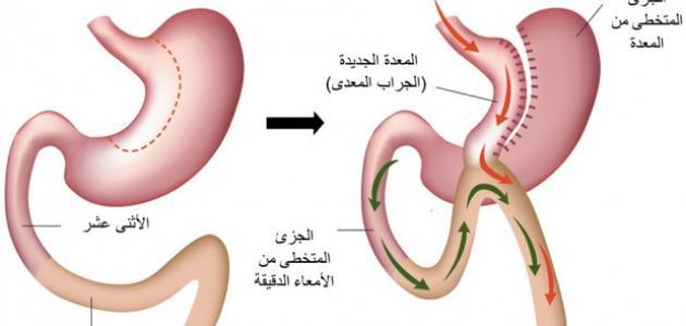 طريقة غسيل المعدة