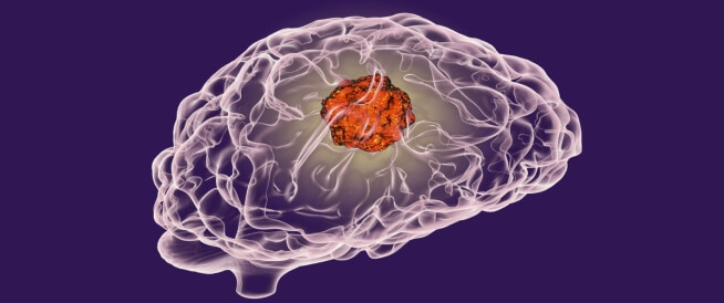 علاج أورام المخ بدون جراحة هل هو ممكن؟