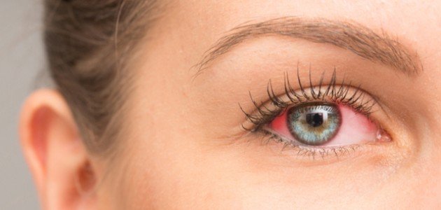 علاج احمرار العين بالاعشاب