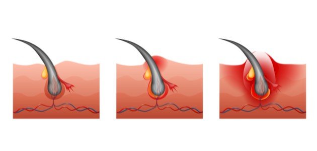 علاج التهاب بصيلات الشعر بالاعشاب