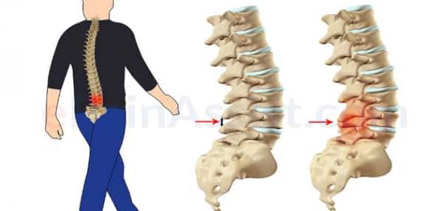 علاج الديسك بالأعشاب حقيقة أم خرافة قد تضرك؟