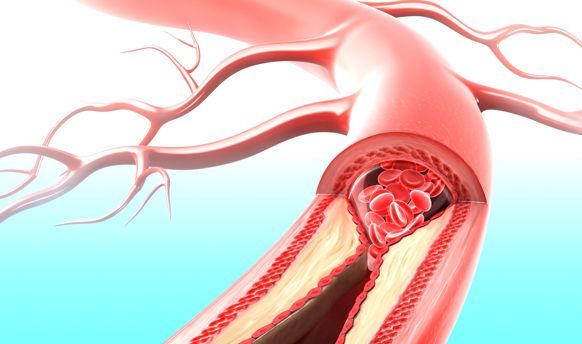 علاج الكوليسترول بالغذاء هل هو مُمكن؟