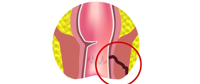 علاج الناسور بالطرق المختلفة