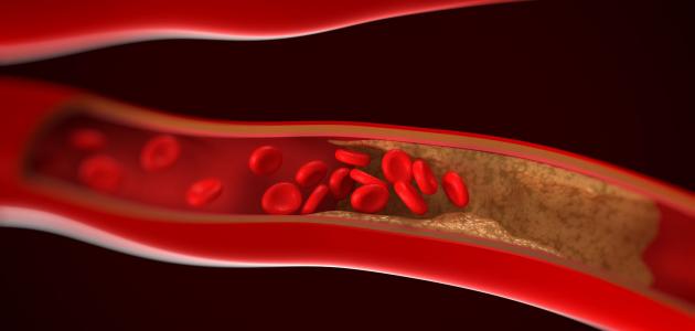 علاج تصلب الشرايين