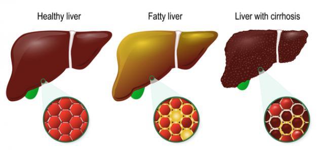 علاج تليف الكبد