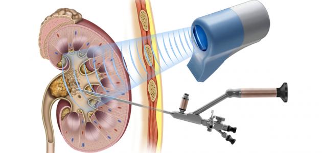 علاج حصوات الكلى