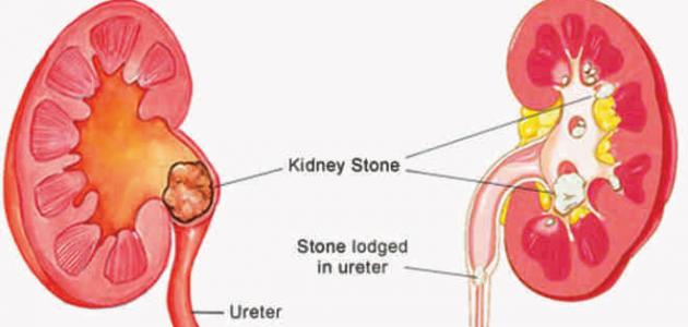 علاج حصى الحالب