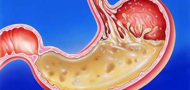 علاج حموضة المعدة والحرقان