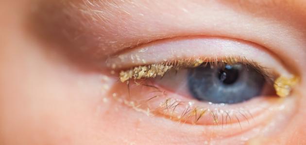 علاج رمد العين للأطفال