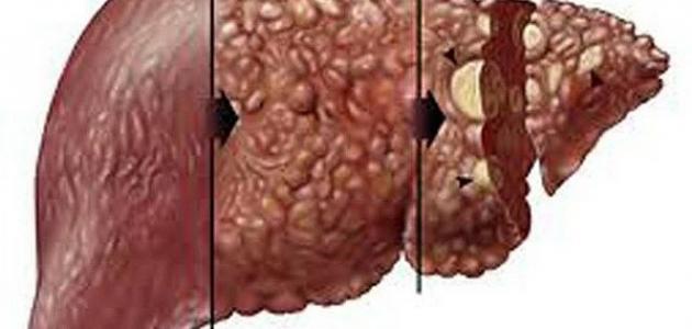 علاج سرطان الكبد