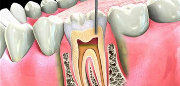 علاج عصب الاسنان