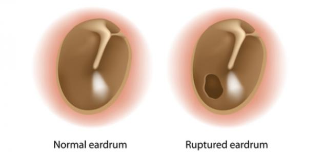 علامات ثقب طبلة الأذن