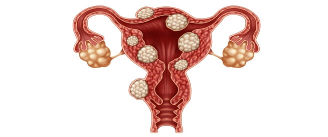 عملية استئصال الورم الليفي خارج الرحم