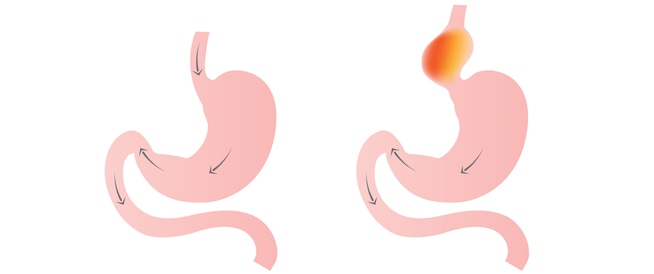 فتق المعدة الأسباب والأعراض والعلاج