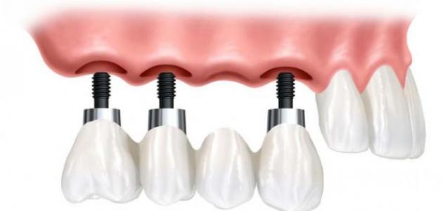 كيف تتم زراعة الأسنان