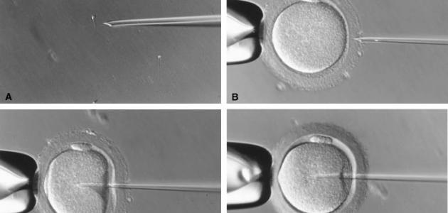 كيف تتم عملية الحقن المجهري