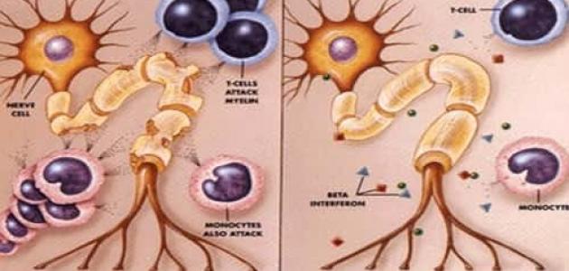 كيف يحدث التصلب اللويحي وما هي أسبابه؟