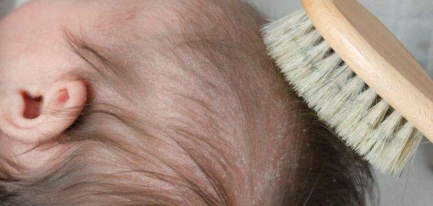 كيفية التخلص من قشرة شعر الرضيع