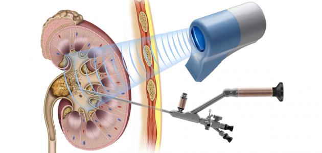 كيفية تفتيت حصوات الكلى