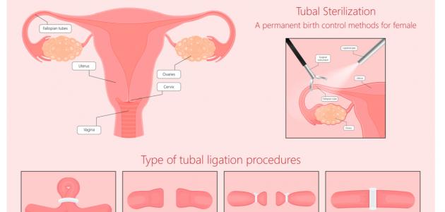 كيفية ربط الرحم لمنع الحمل
