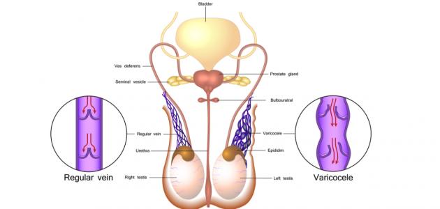 ما أسباب دوالي الخصية