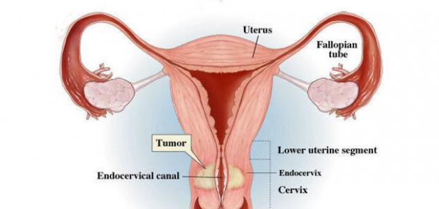 ما اعراض سرطان عنق الرحم