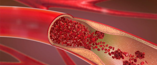 ما الفرق بين تصلب الشرايين وارتفاع ضغط الدم