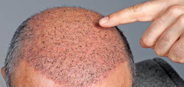 ما حكم زراعة الشعر