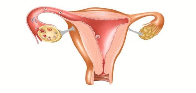 ما علاج سماكة بطانة الرحم