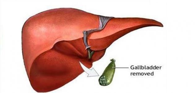 ما هو الغذاء المناسب بعد استئصال المرارة
