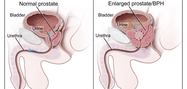 ما هو سبب مرض البروستات