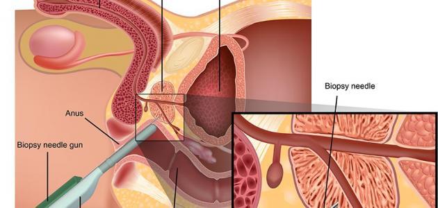 ما هو علاج تضخم البروستاتا بالاعشاب