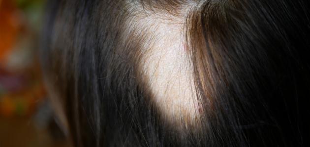 ما هو علاج ثعلبة الشعر
