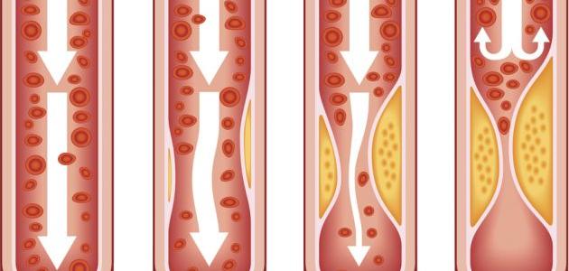 ما هو مرض تصلب الشرايين