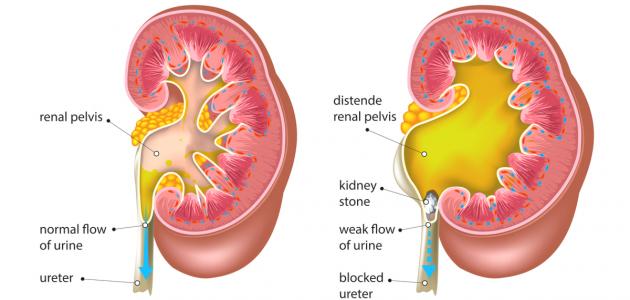 ما هي أسباب تكون الحصى في الكلى