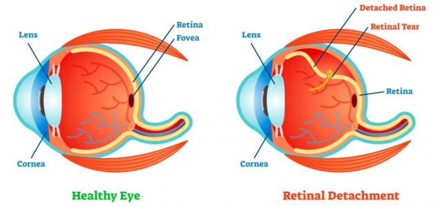 ما هي أمراض شبكية العين