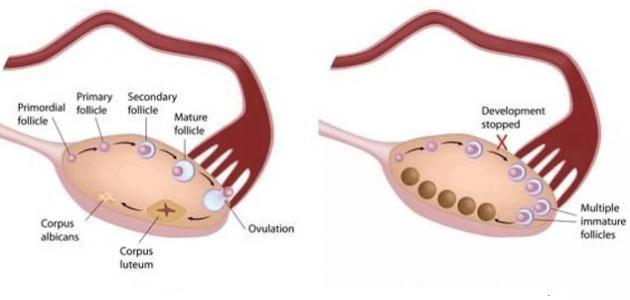 ما هي اضرار تكيس المبايض