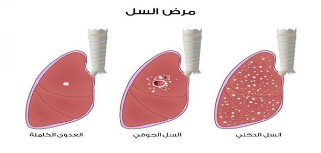 ما هي انواع امراض الرئة