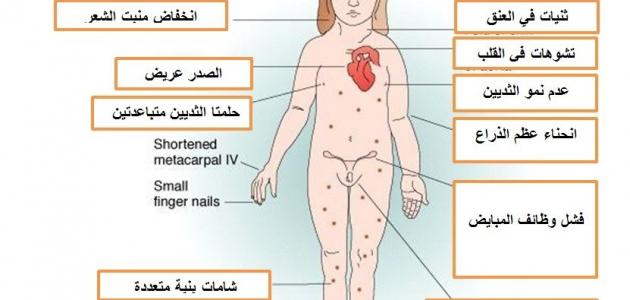 ما هي متلازمة تيرنر