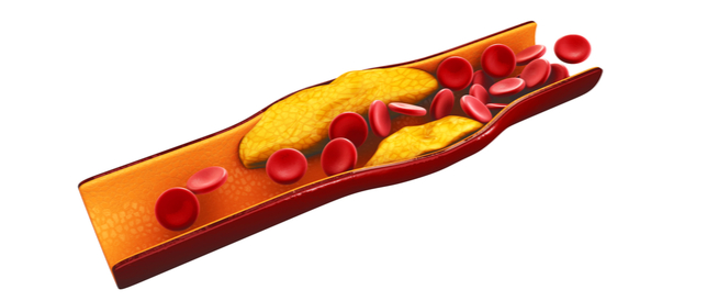 متى يعتبر الكوليسترول مرتفعًا؟