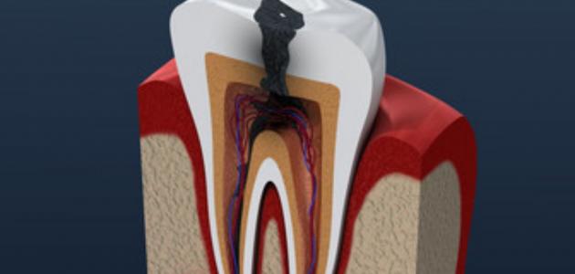 مخاطر تسوس الاسنان