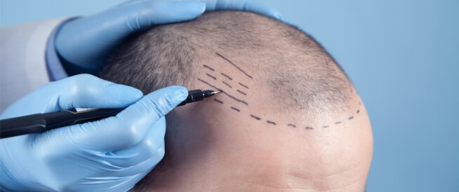 مخاطر زراعة الشعر تعرف عليها