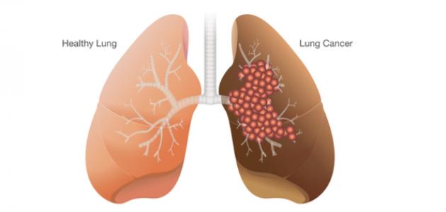 مراحل تطور مرض سرطان الرئة