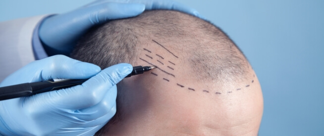 مراحل زراعة الشعر وأهم التعليمات والنصائح